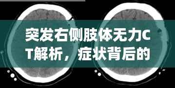 突发右侧肢体无力CT解析，症状背后的真相揭秘