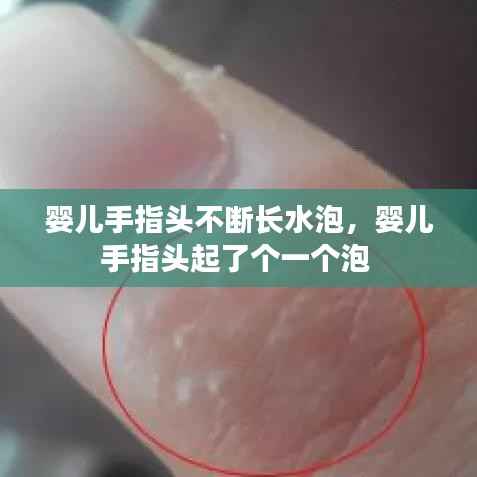 婴儿手指头不断长水泡，婴儿手指头起了个一个泡 