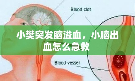 小樊突发脑溢血，小脑出血怎么急救 