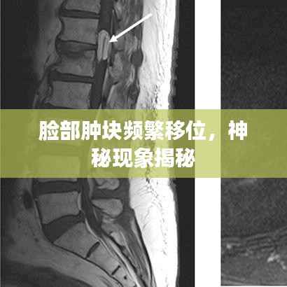 脸部肿块频繁移位，神秘现象揭秘