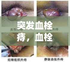 突发血栓痔，血栓痔是急性的吗 