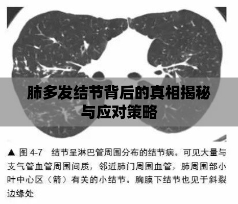 肺多发结节背后的真相揭秘与应对策略